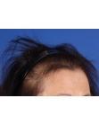 Before Hair Transplant&nbsp;Hair Thinning